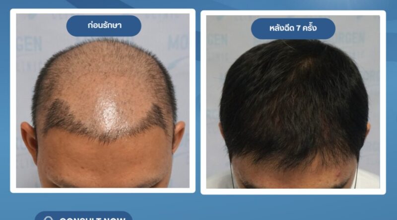 มอเก้นคลินิก ฉลองครบรอบ 5 ปี เปิดตัวโปรแกรมปลูกผมโดยไม่ต้องผ่าตัด  พร้อมมอบส่วนลดพิเศษถึง 30%